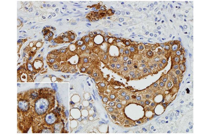 Descubren el vínculo entre un retrovirus y el cáncer de próstata