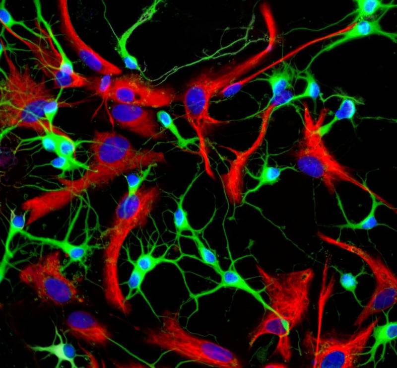 Desvelan qué provoca los ataques en la epilepsia focal