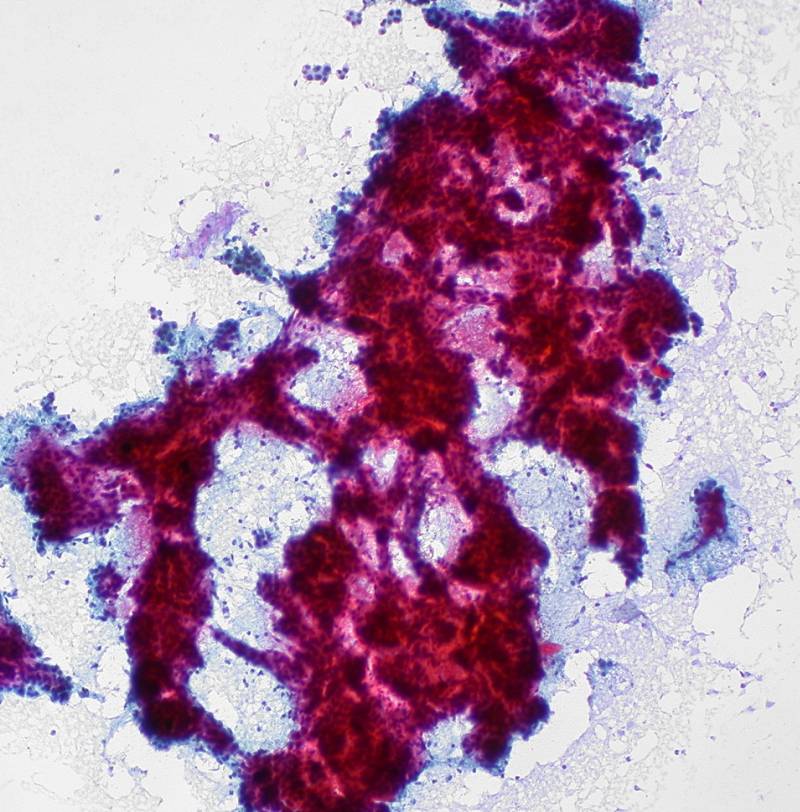 Encuentran un nuevo supresor del cáncer de hígado