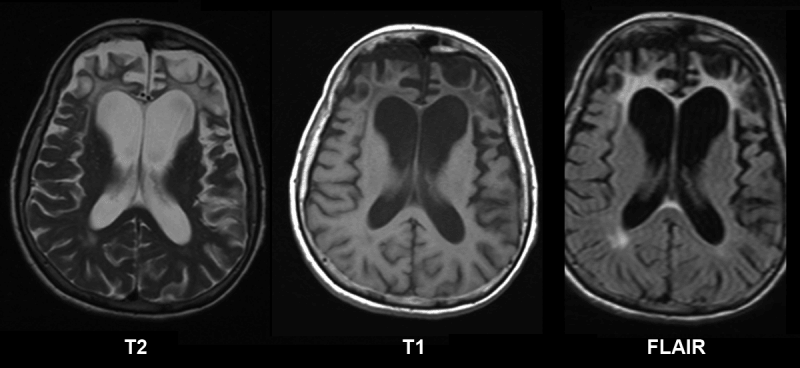 ¿Es hereditaria la alteración que causa la demencia?