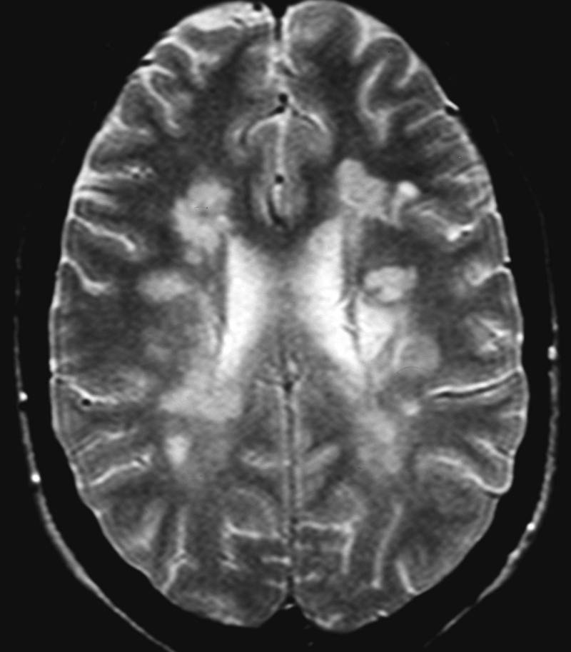 Resonancia magnética cerebral 