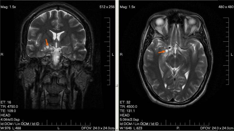 glioma