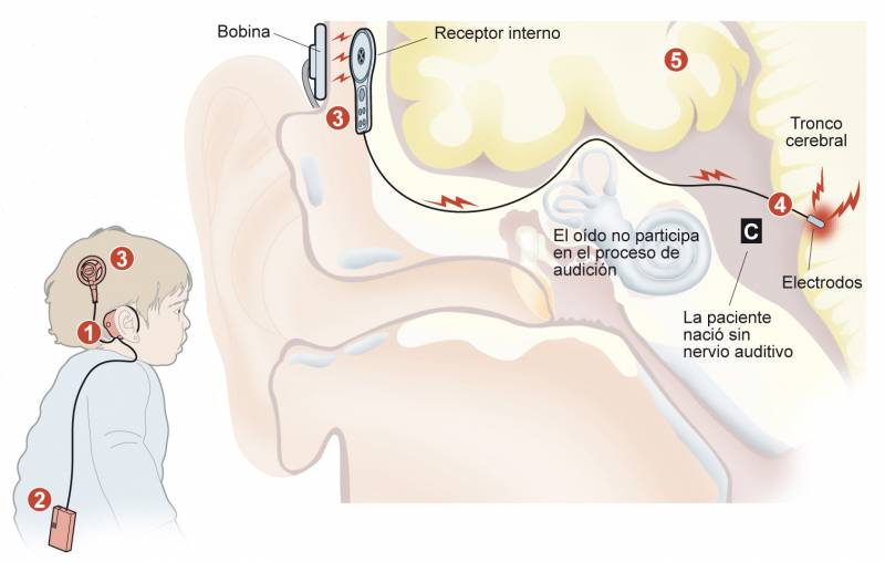 implante auditivo