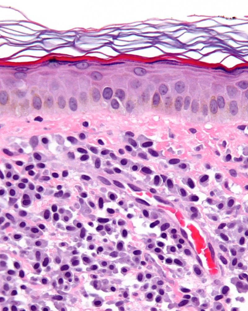 Micrografía de una mastocitosis. Biopsia de piel. Imagen: Wikipedia 