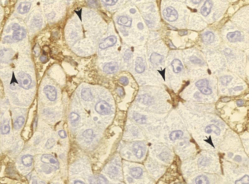 ICAM-1 se confina en la parte apical (flechas) de las células epiteliales de hígado que permanecen sanas y funcionales. Inmunohistoquímica de un hígado infectado con el virus de la hepatitis C. 