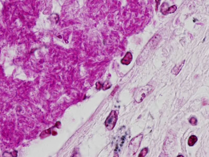 Pulmón de un paciente enfermo de tuberculosis