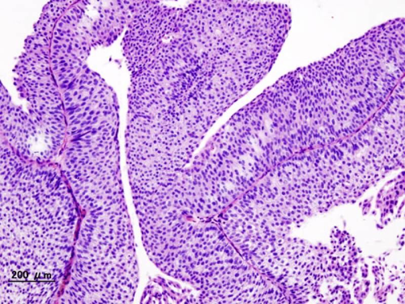 Orinar con frecuencia protege del cáncer de vejiga