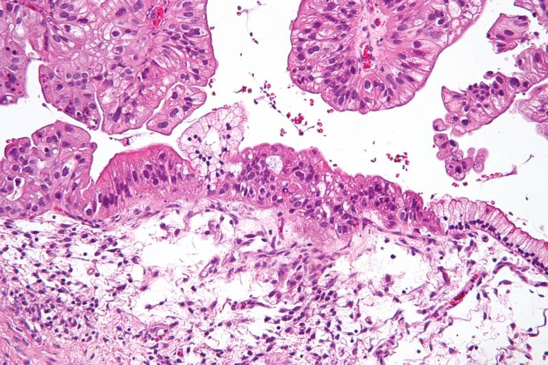 Un nuevo estudio, publicado on line en la revista Science Express, muestra un promedio de 20 genes mutados por cada cáncer de células claras de ovario.