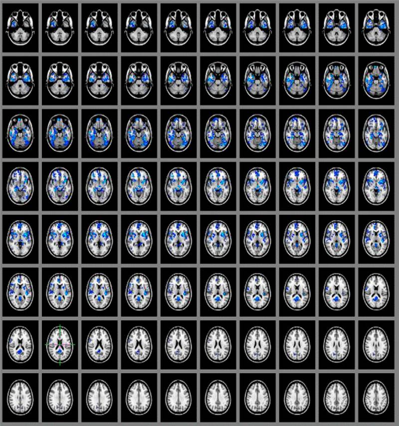 Una vez que el sujeto asimila la psilocibina, se aprecia en el escáner de su cerebro una disminución en el torrente sanguíneo, sobre todo en las zonas centrales, como el tálamo y la circunvolución del cíngulo anterior y posterior. Imagen: PNAS