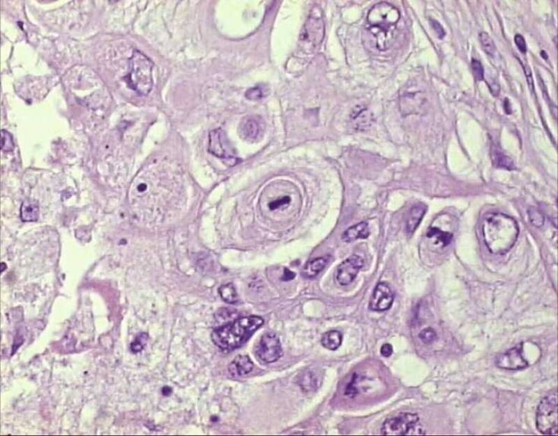 Tejido bronquial carcinoma no microcitico