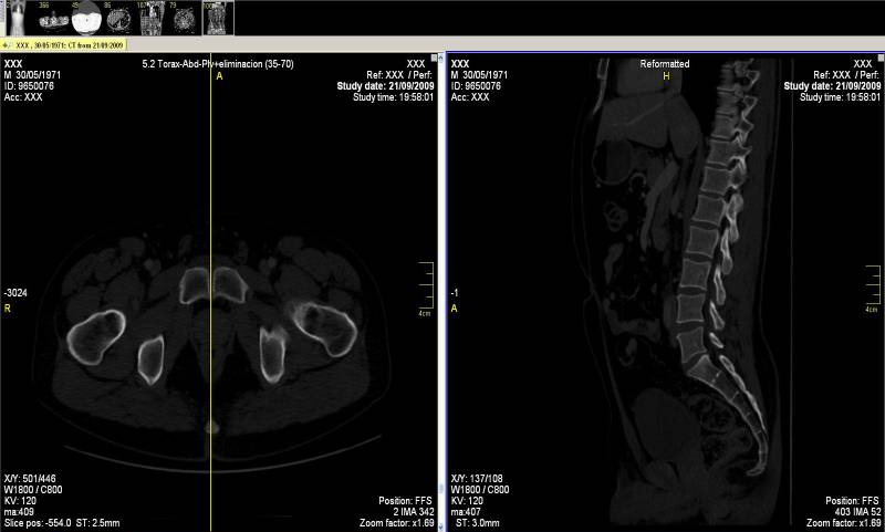 A la izquierda, un corte horizontal que pasa por la sínfisis del pubis y a la derecha, corte sagital. Imagen: UGR. 