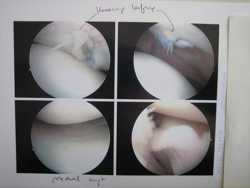 Utilizan la membrana amniótica para reparar el cartílago articular humano