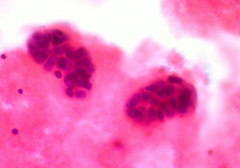 Desciende la incidencia del cáncer de mama en España 