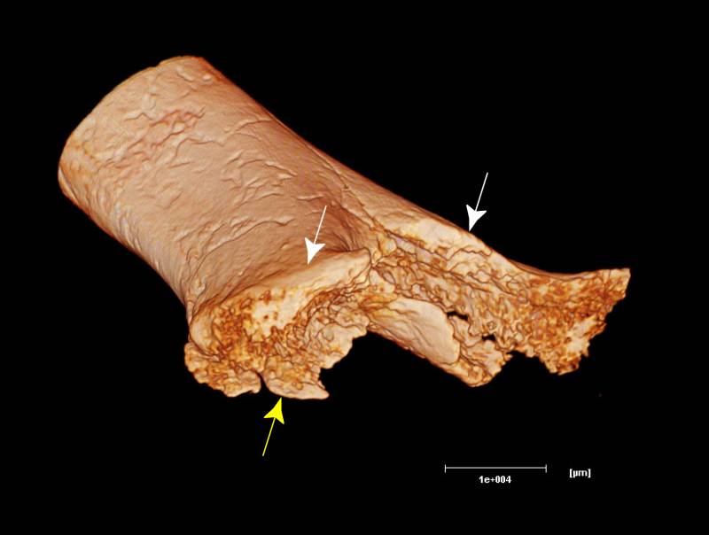 Descubren evidencias de una operación quirúrgica de hace casi 7.000 años