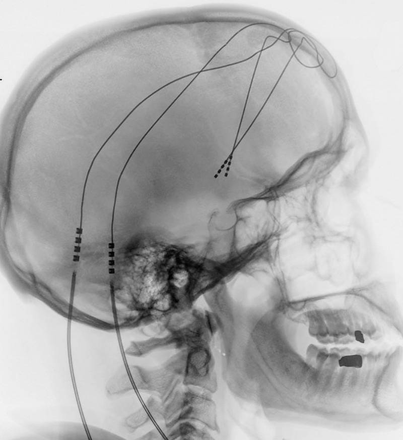 La estimulación cerebral profunda, una terapia para la depresión grave