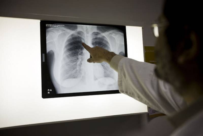 La población mayor o con VIH es la más frágil frente a la tuberculosis