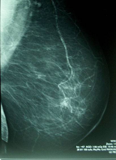 Un nuevo inhibidor tumoral muestra resultados prometedores para el tratamiento del cáncer de mama