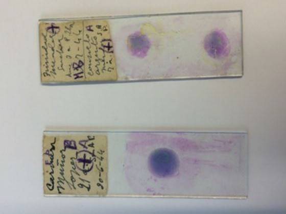 Así era la malaria erradicada hace más de 50 años en Europa