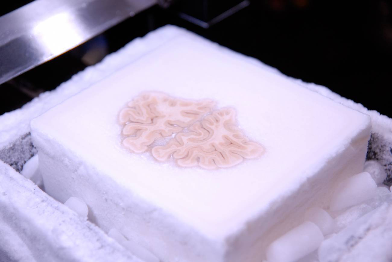 Cortes del cerebro amnésico más famoso. / J Annese