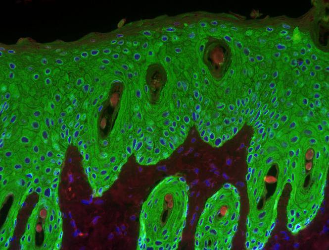 piel hiperproliferativa