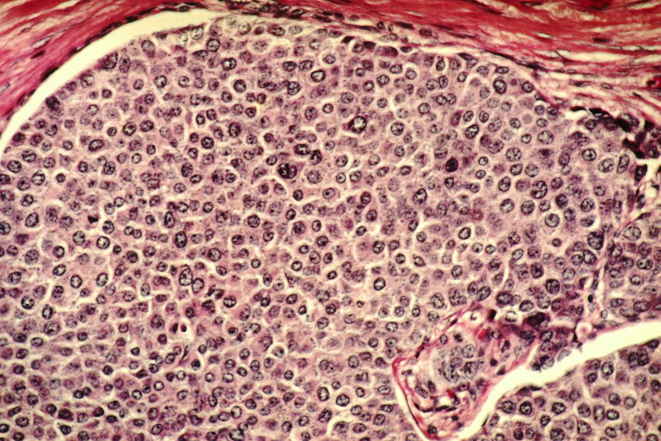 Descubren cómo actúa el gen BRCA2 en la supresión de tumores de ovario y mama