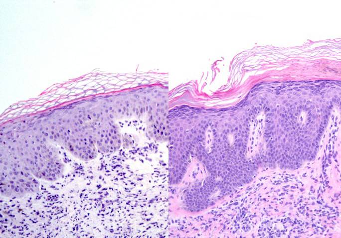 Encontradas dos nuevas estrategias para curar la psoriasis
