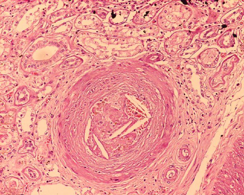 Identifican 59 nuevas variantes genéticas asociadas a los niveles de colesterol y triglicéridos en sangre