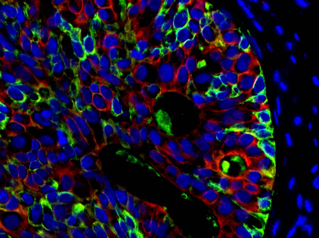 Identifican por primera vez las células que originan el cáncer de próstata humano