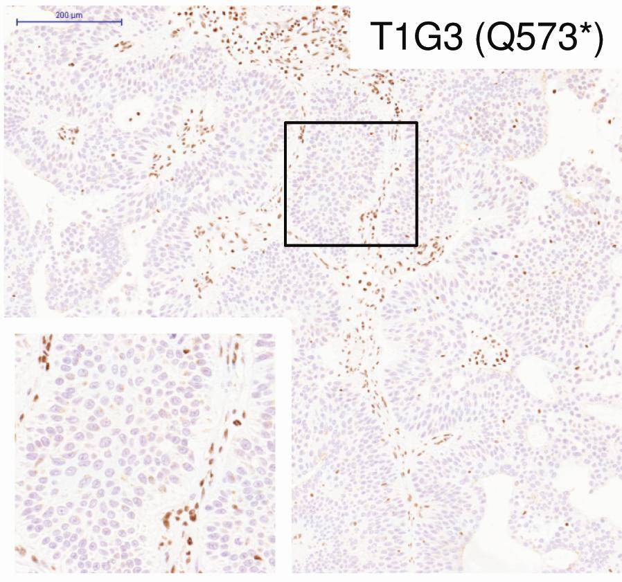 tumor vejiga