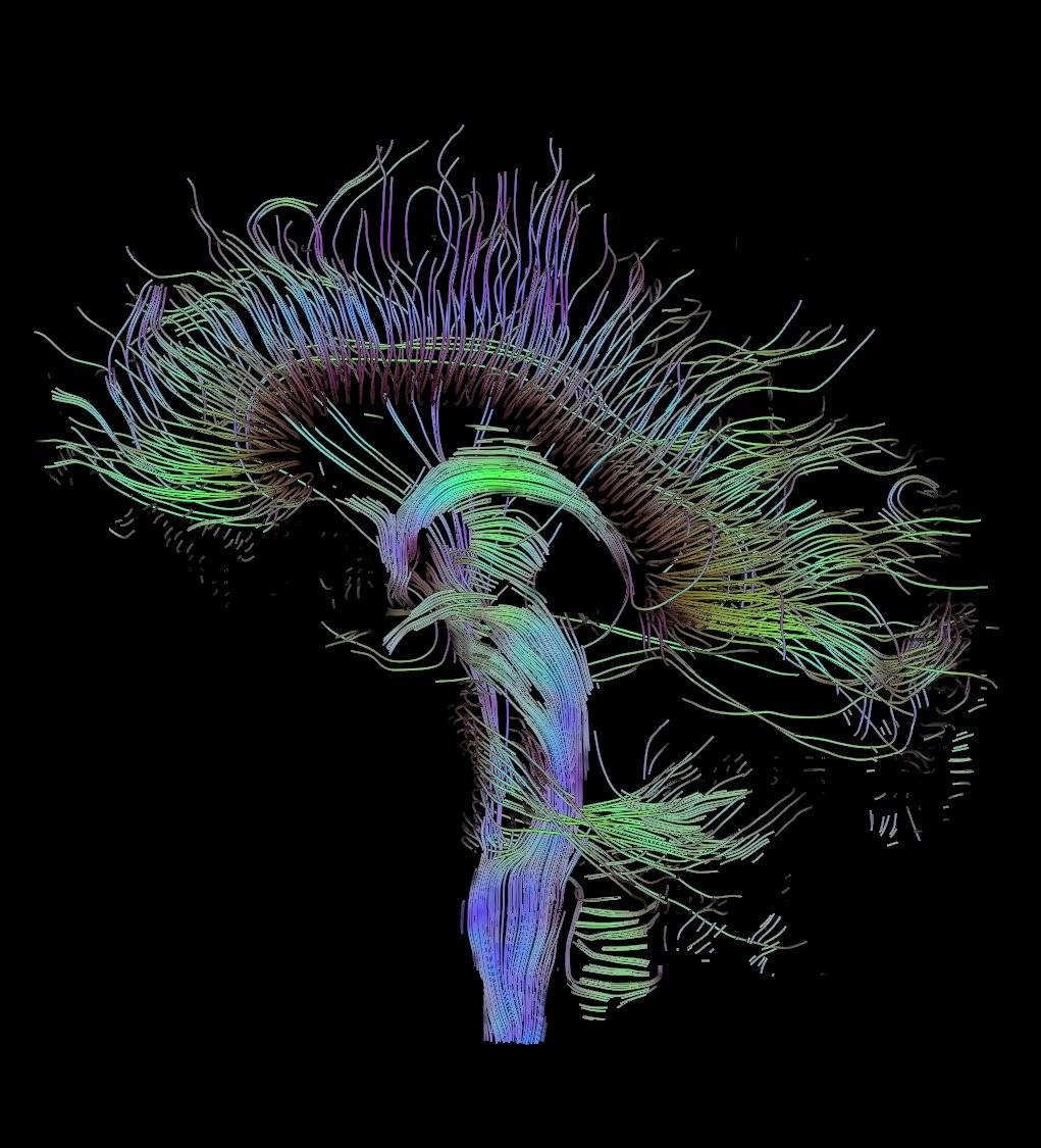 La conectómica estudia las redes neuronales en el cerebro enfermo