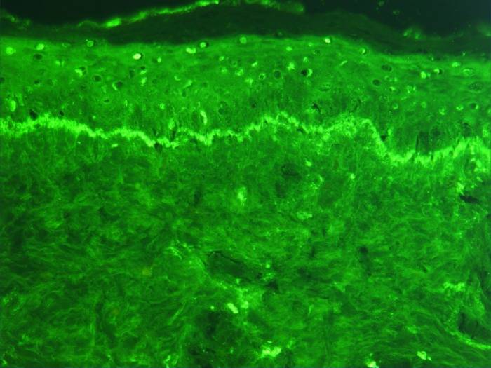 Los cambios epigenéticos desempeñan un papel clave en enfermedades como el lupus