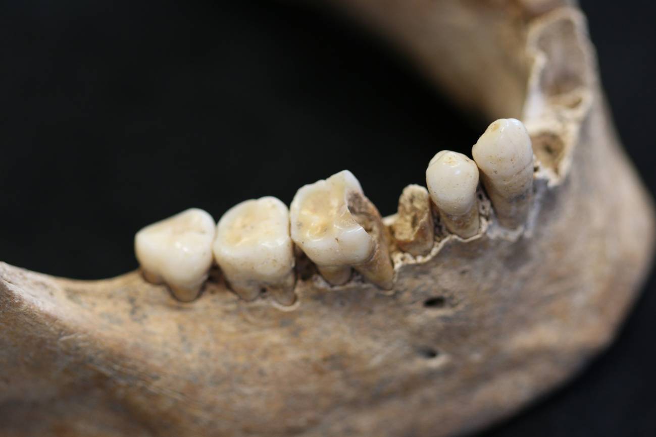Obtienen material genético antiguo de la bacteria de la caries