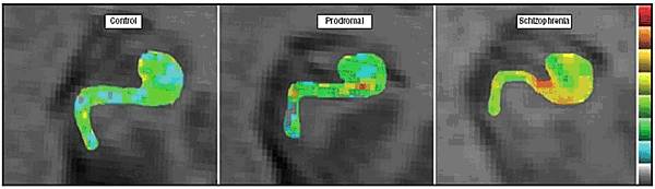 Relacionan un defecto cerebral con la esquizofrenia temprana