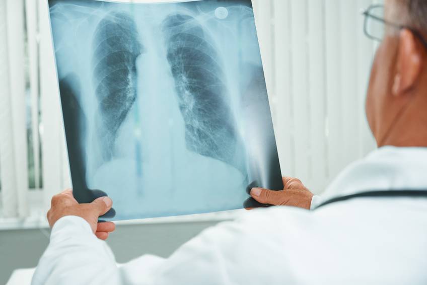 Hubo 1,8 millones de casos nuevos y 1,6 millones de muertes de cáncer de tráquea, bronquios y pulmón. / Fotolia
