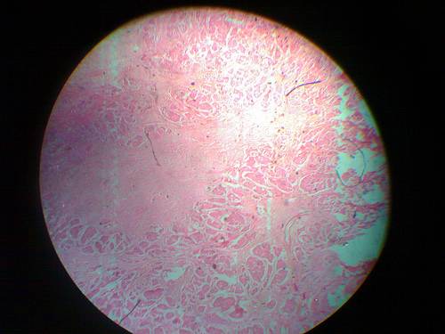Una característica del tejido mamario puede predecir el riesgo de cáncer de las mujeres
