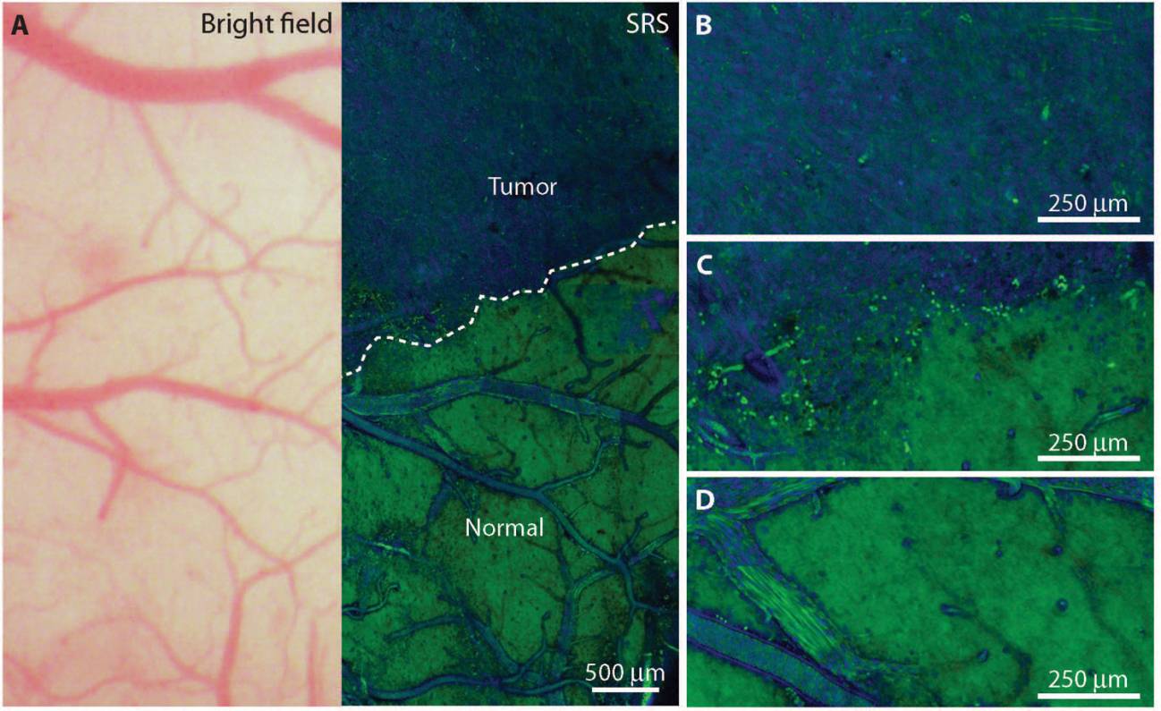 Una nueva tecnología láser detecta rápidamente los tumores cerebrales