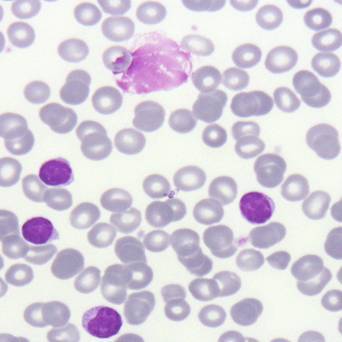 Descifran los primeros genomas de pacientes con leucemia linfática crónica (y II)