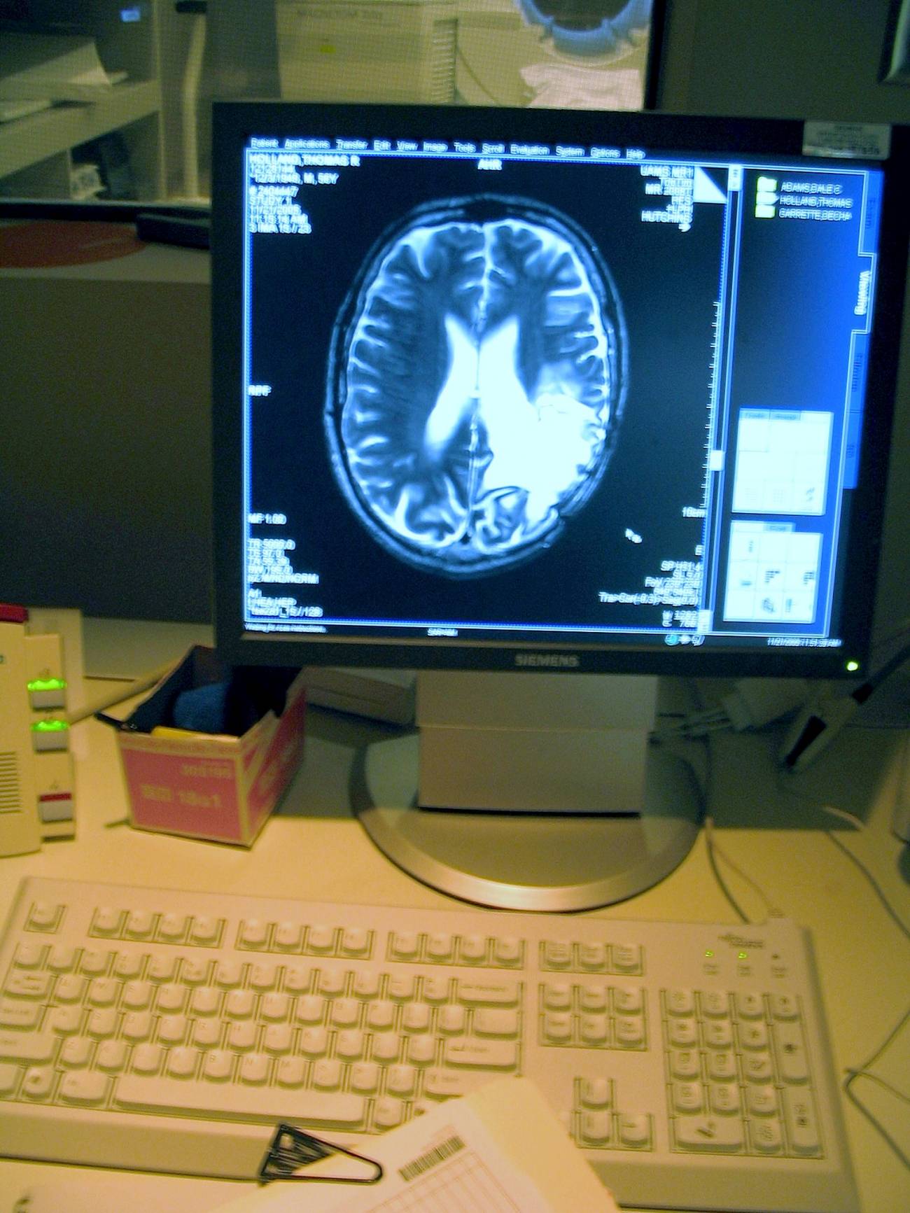 Los biomarcadores pueden predecir la respuesta a la terapia de un tumor cerebral