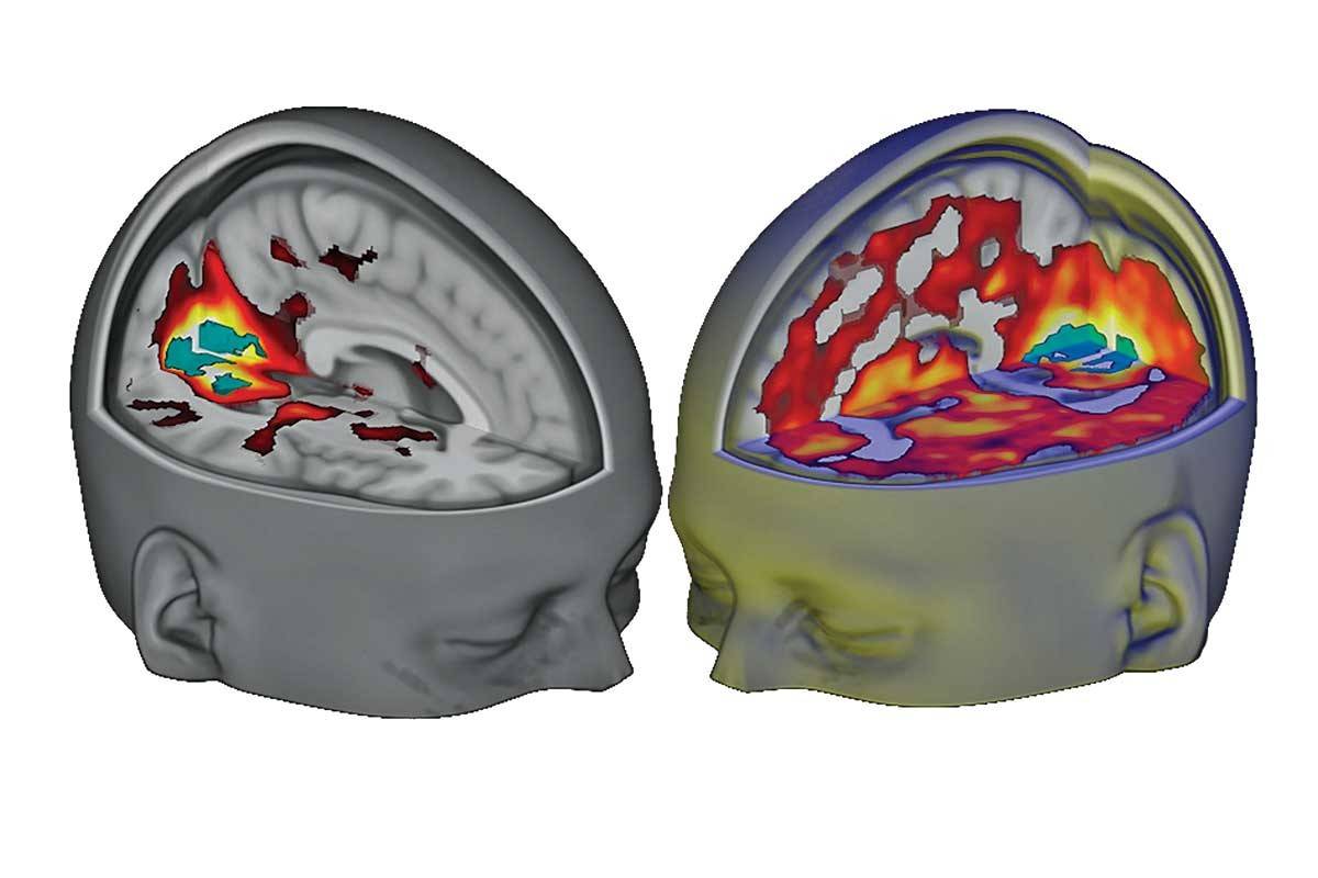 Así se reconecta el cerebro durante un ‘viaje’ de LSD 