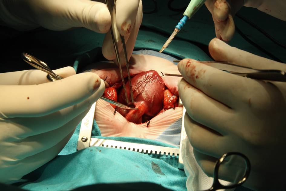 Descubiertas las claves genéticas del fallo de la válvula mitral