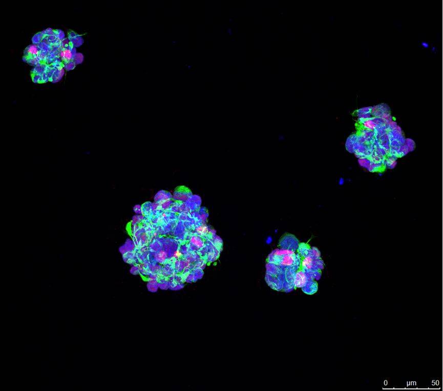 Microesferas para atacar el tumor cerebral más agresivo