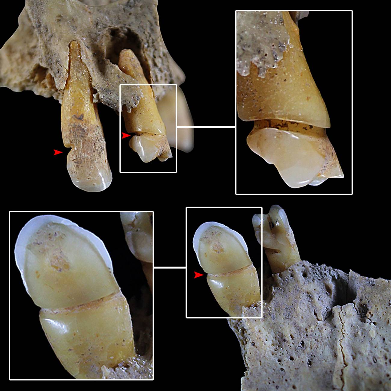 Dentición del individuo 90 de Castellón Alto con evidencias de uso para masticatorio de la dentición. / Ángel Rubio Salvador