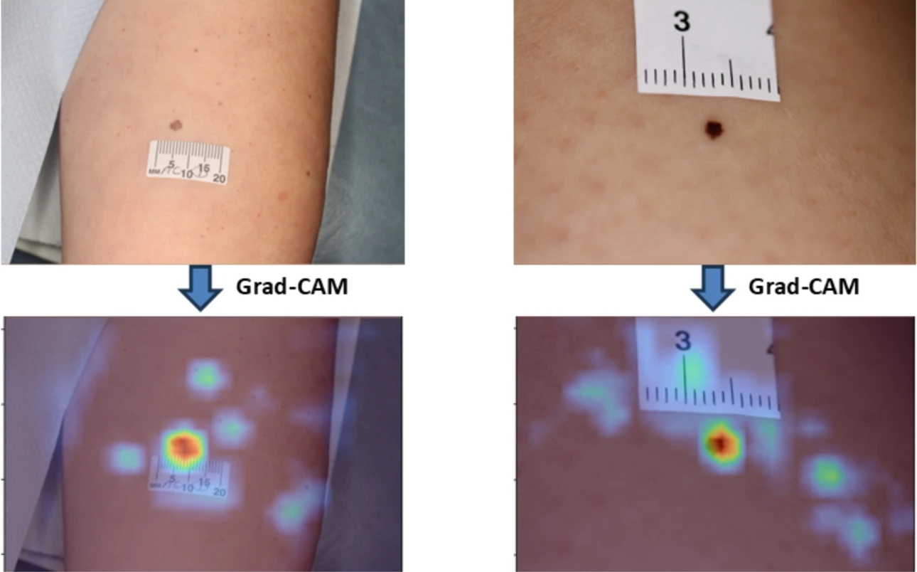 Generación de mapas de calor utilizando Grad-CAM para comprobar si el modelo está enfocado en el área correcta de la lesión.  / Scientific Reports