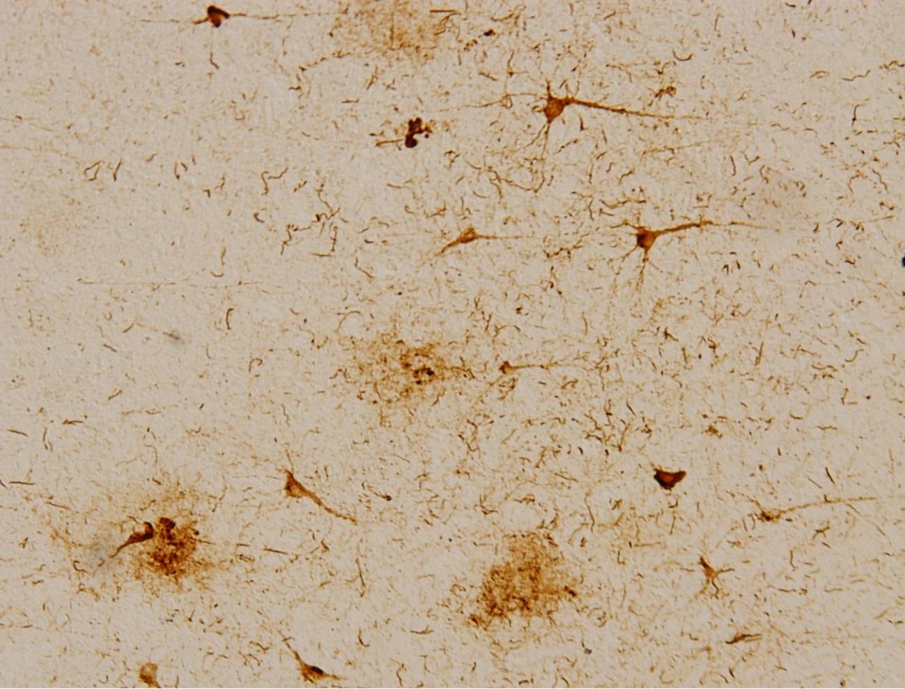 sección de corteza frontal humana postmortem de un paciente con enfermedad de Alzheimer