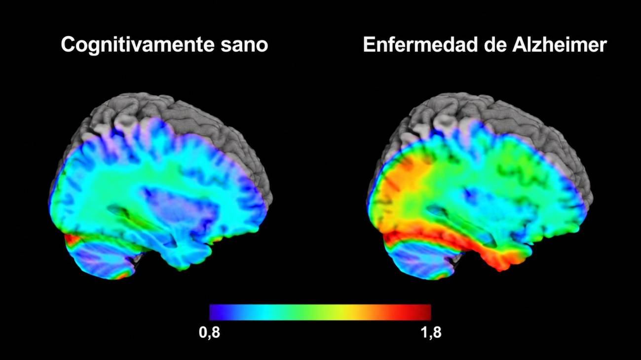 imagen cerebro sano y enfermo