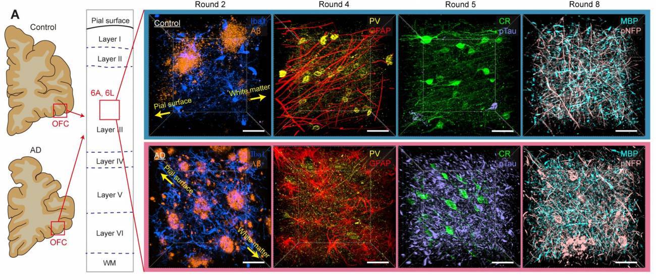 Comparación de lo que puede verse en la corteza orbitofrontal de muestras de cerebro de control y de alzhéimer: en la ronda 2 de etiquetado se aprecia mucha más beta amiloide (AB) en la muestra con patología (fila inferior). Lo mismo ocurre con la Tau fosfirilada (pTau) en la ronda 5. / Laboratorio Chung | MIT