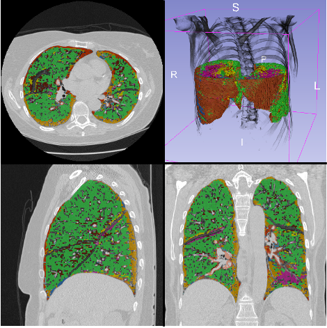 diferentes tipos de tejido pulmonar