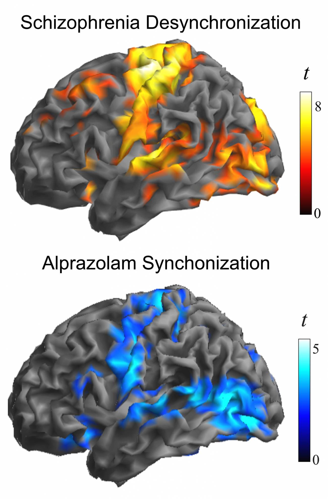 Imagen que muestra la similitud entre las áreas afectadas en el cerebro