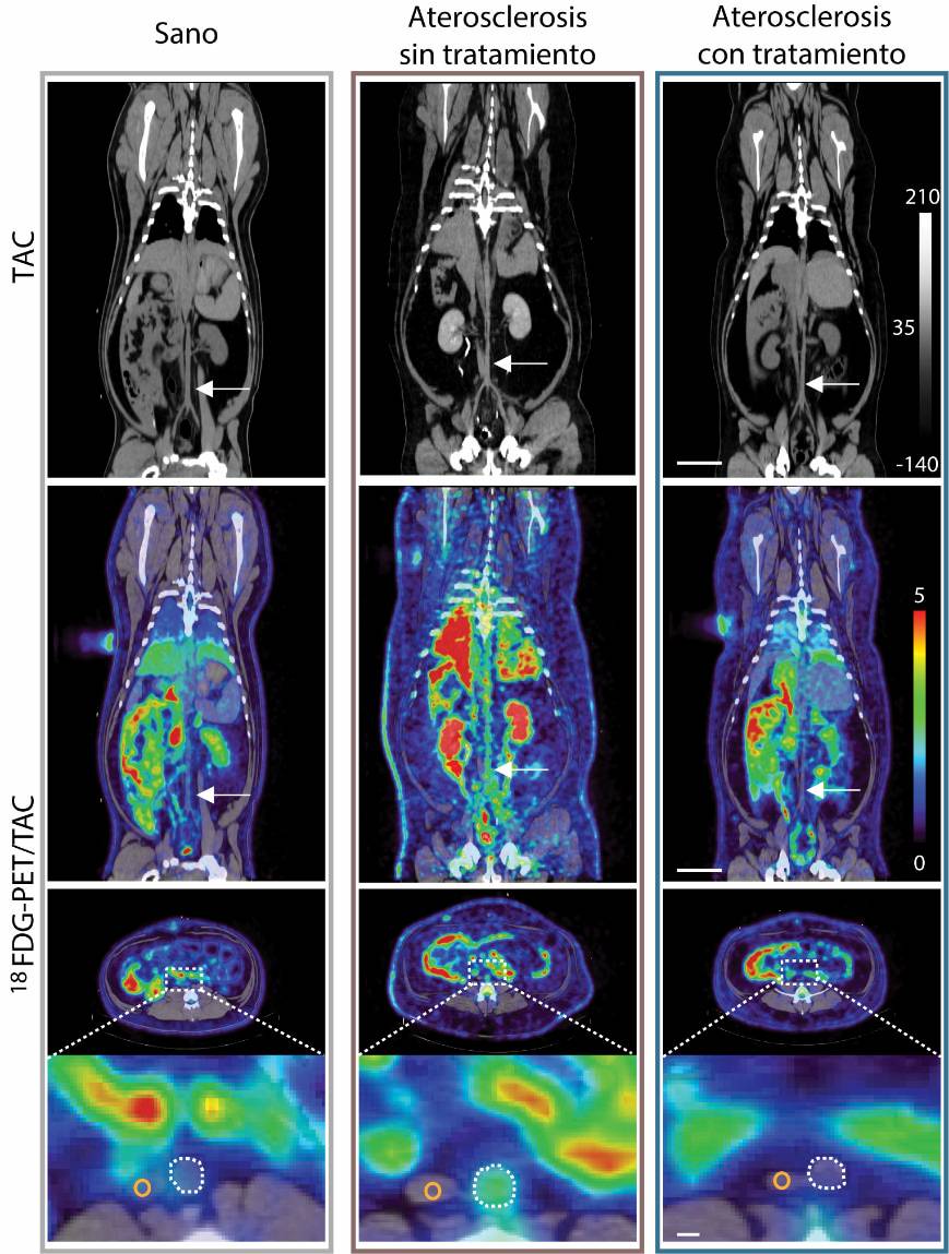 Las imágenes de TAC y 18FDG-PET muestran la actividad de la aterosclerosis en la aorta abdominal de cerdos. La fila superior presenta la imagen anatómica (TAC) y su señal metabólica superpuesta (18FDG), que revela el metabolismo activo. Abajo, un corte transversal destaca la aorta. La captación de 18FDG es baja en cerdos sanos, aumenta con la aterosclerosis sin tratar y se reduce tras el tratamiento, indicando menor actividad de la enfermedad. /CNIC