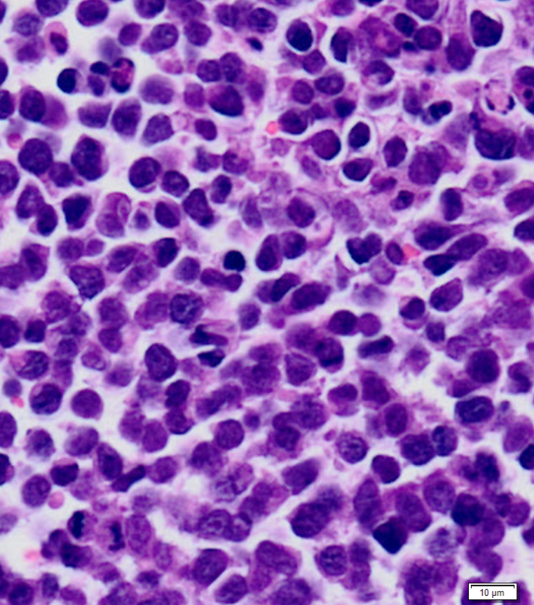 sarcoma Ewing